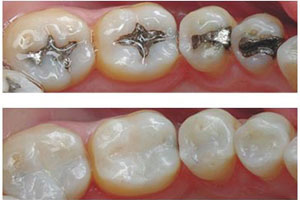 TOOTH FILLINGS AND JEWELLERY