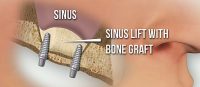 sinus graft dental implants