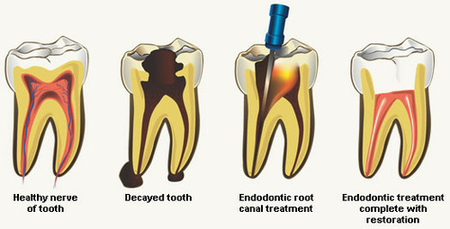
Root Canal Treatment